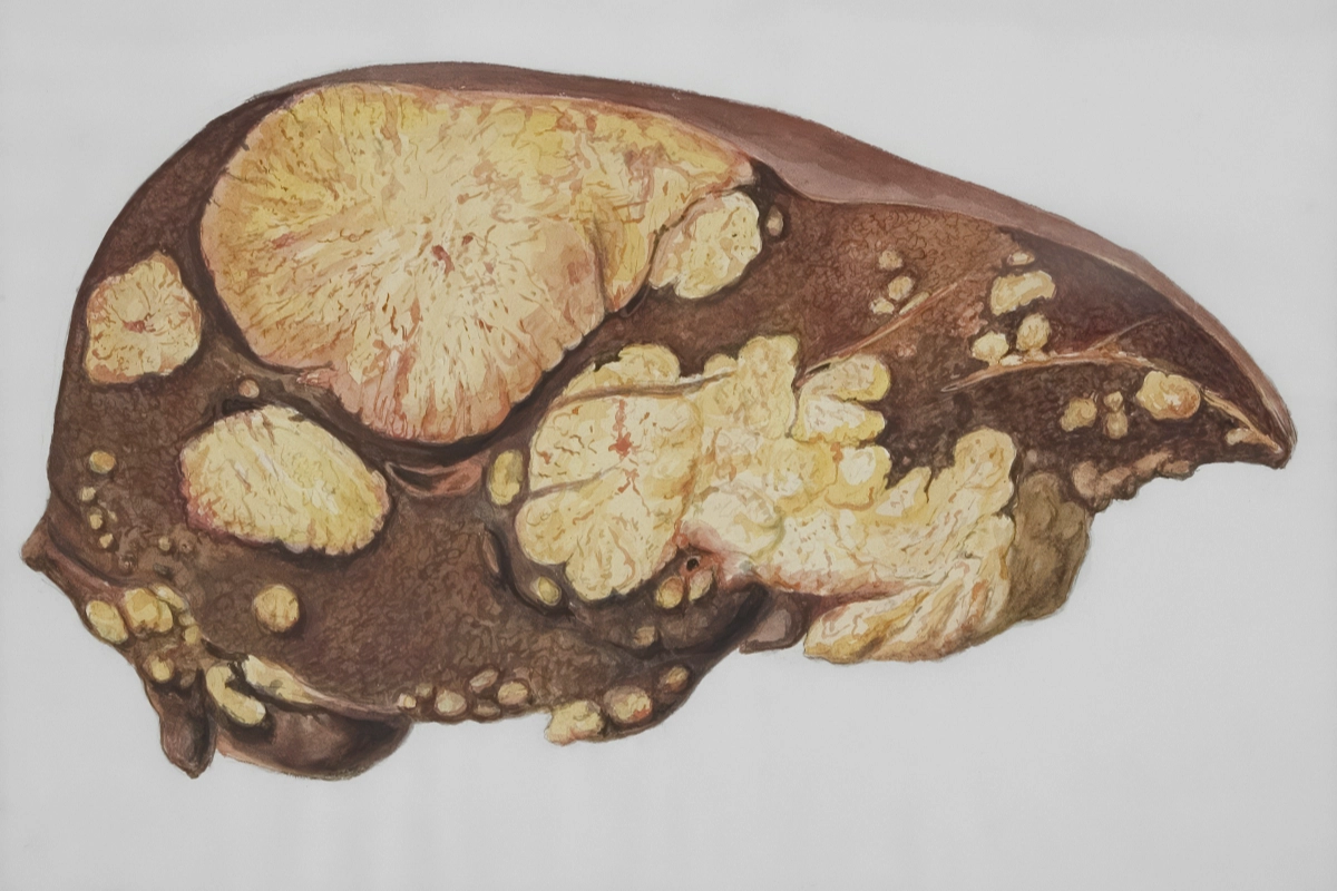 Julho amarelo, campanha alerte para hepatites virais